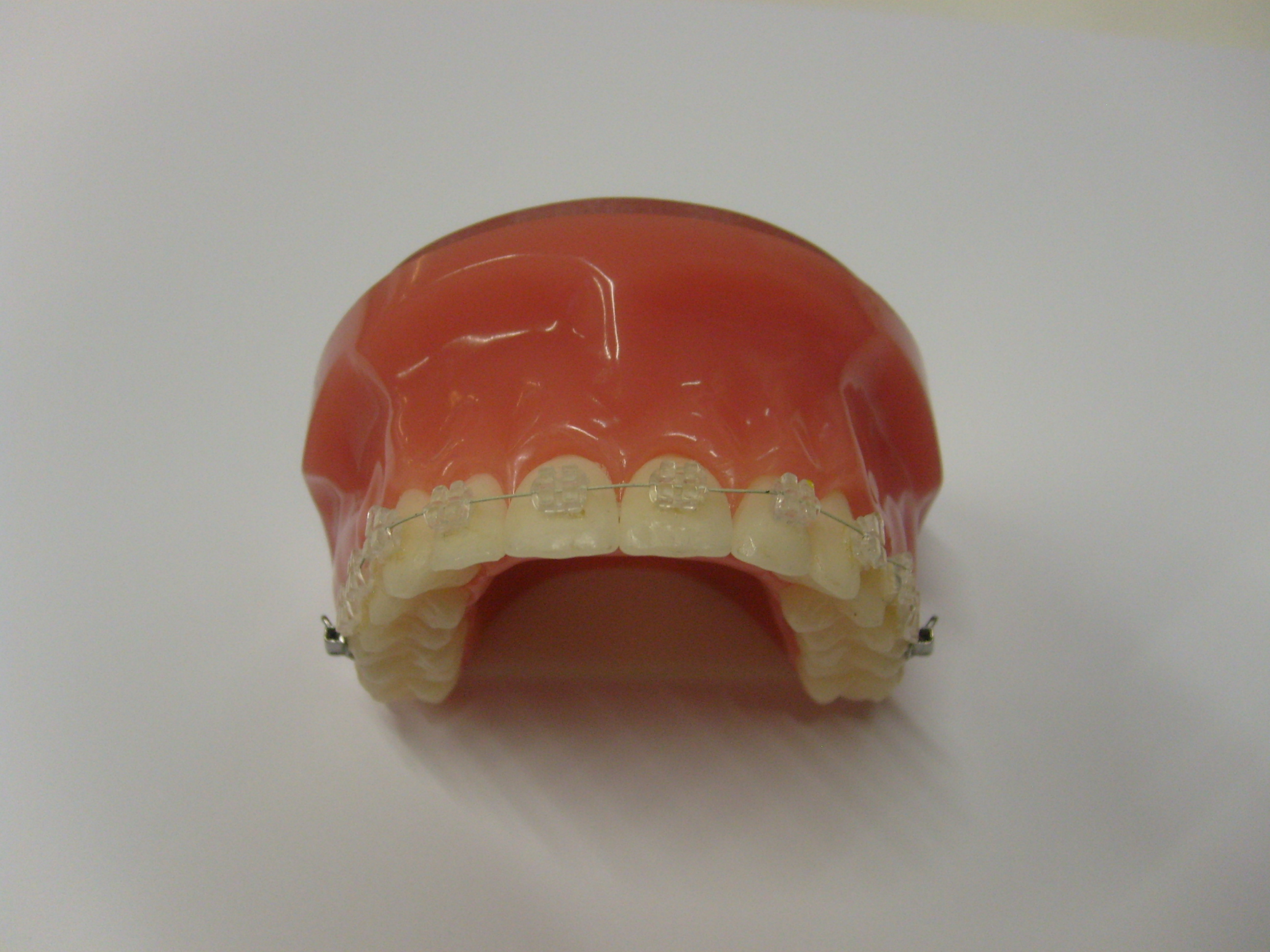 Zahnfarbene Brackets 2